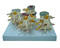 Spine herniated disc model